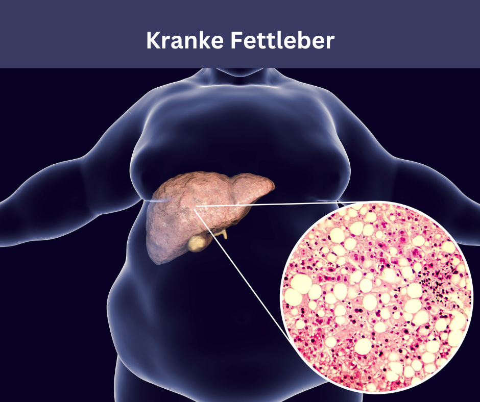 Titel Kranke Fettleber. Eine Kranke Fettleber weiß und rosa, ist abgebildet bei einer übergewichtige Frau die durchsichtig scheint in den Farben Schwarz-Blau.