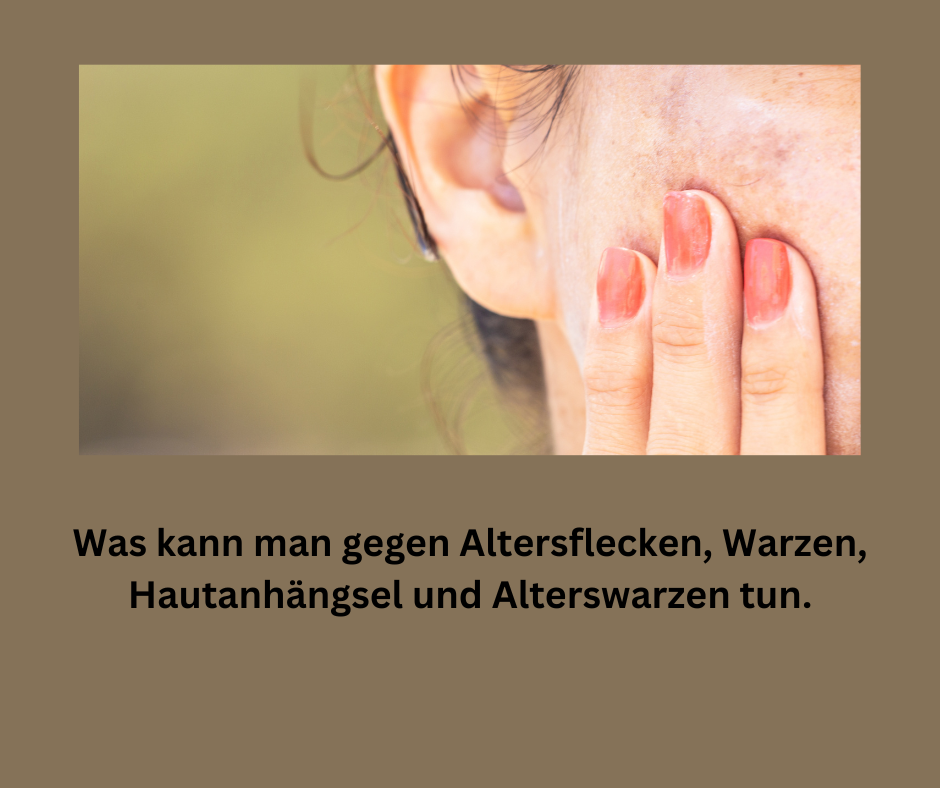 Frau mit Hautprobleme. Altersflecken, Pigmentflecken, Warzen und Hautanhängseln.