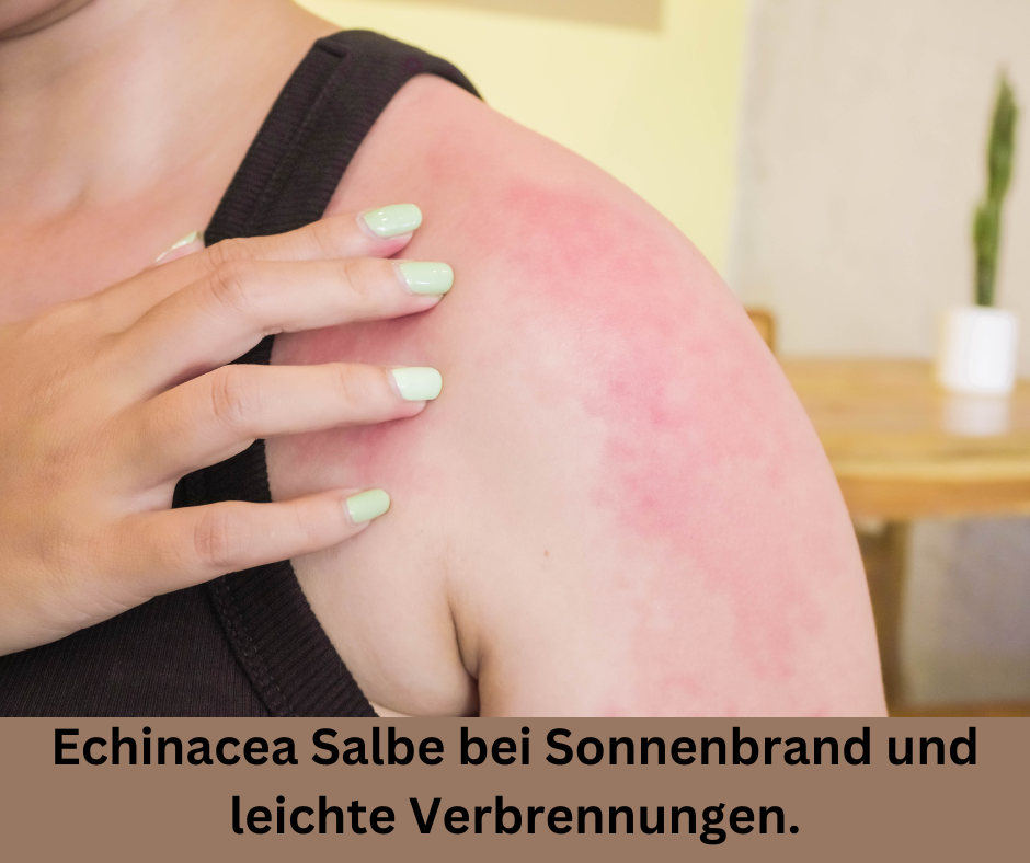 Sonnenbrand auf der Schulter. Schriftzug: Echinacea Salbe bei Sonnenbrand und leichte Verbrennungen.